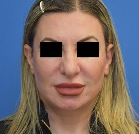 Neal Goldberg, MD facelift after — Scarsdale, NY