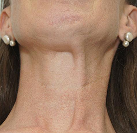 Neck Lift before at Neal Goldberg, MD in Scarsdale, NY