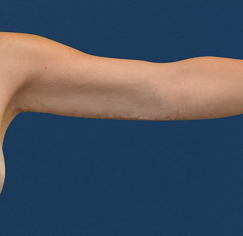 Arm Lift after at Neal Goldberg, MD in Scarsdale, NY