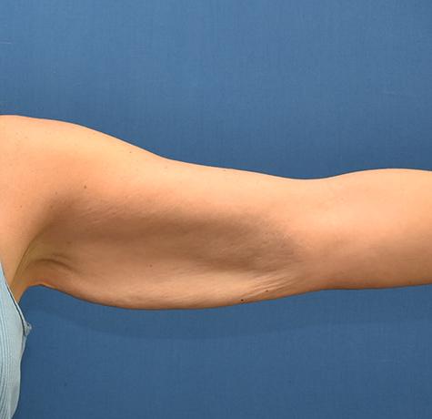 Arm Lift before at Neal Goldberg, MD in Scarsdale, NY