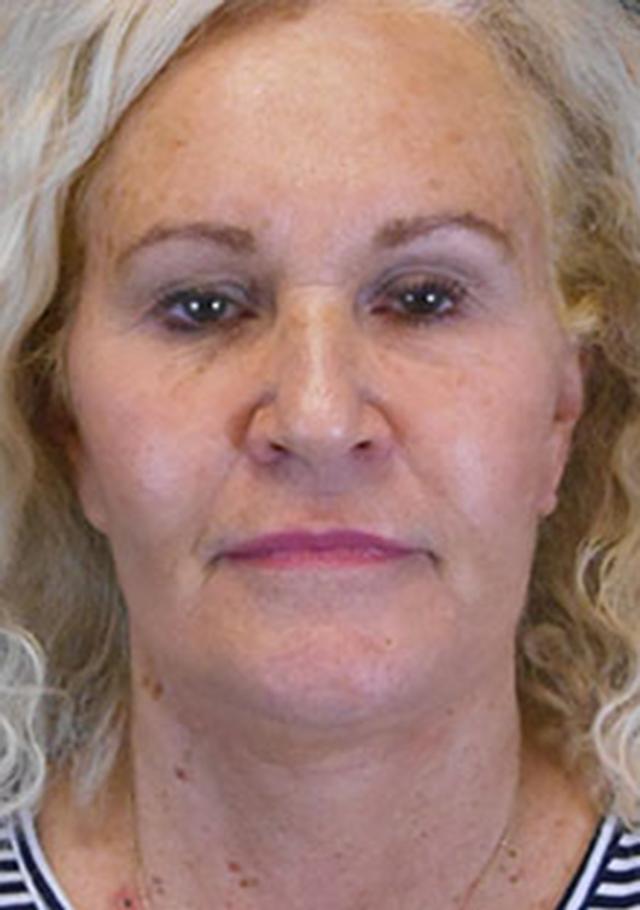 Facelift after at Reynolds Plastic Surgery in Las Vegas, NV