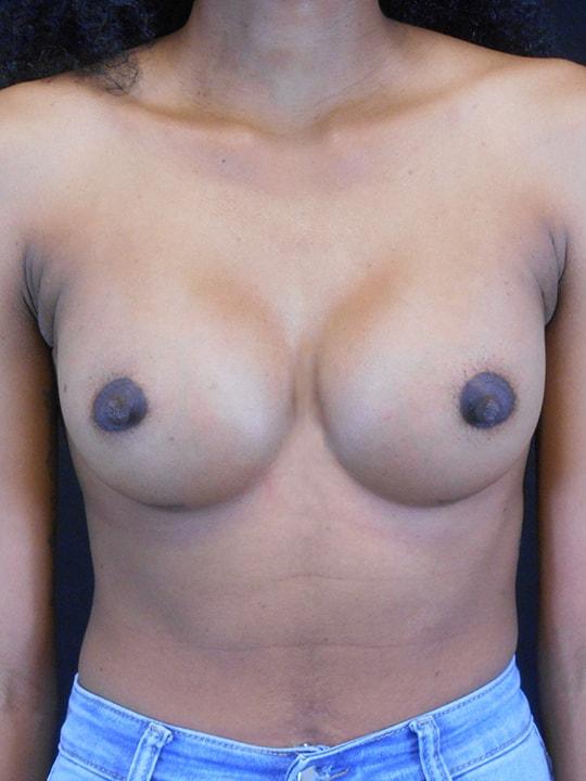 Fat Transfer Breast Augmentation after at Reynolds Plastic Surgery in Las Vegas, NV