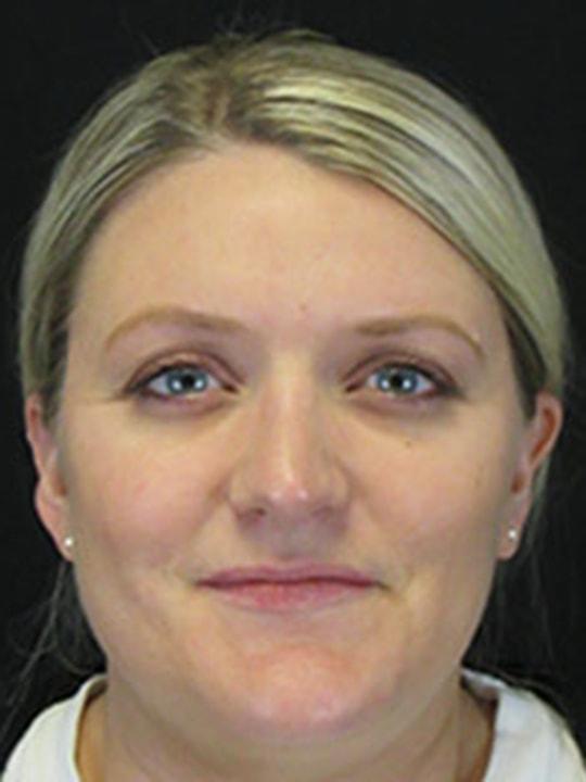 Reynolds Plastic Surgery rhinoplasty after — Las Vegas, NV