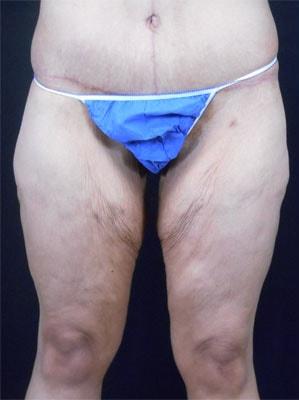 CoolSculpting before at Reynolds Plastic Surgery in Las Vegas, NV