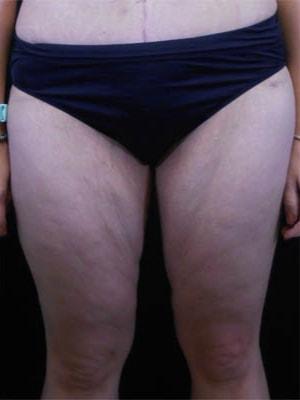 CoolSculpting after at Reynolds Plastic Surgery in Las Vegas, NV