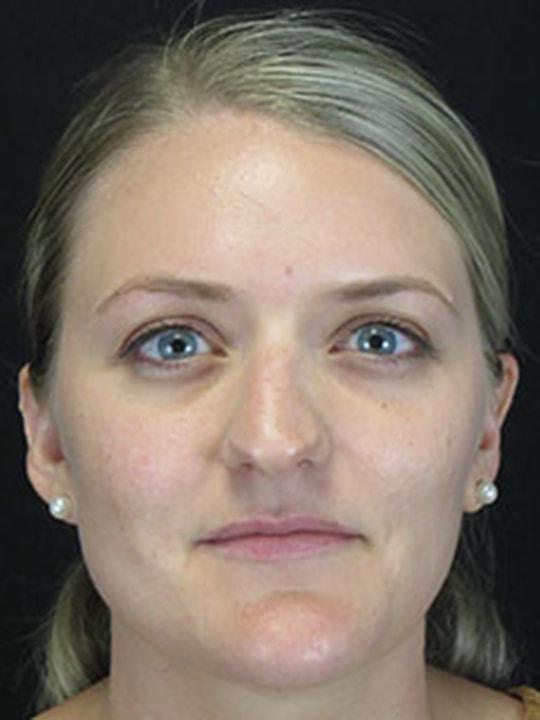 Rhinoplasty before at Reynolds Plastic Surgery in Las Vegas, NV