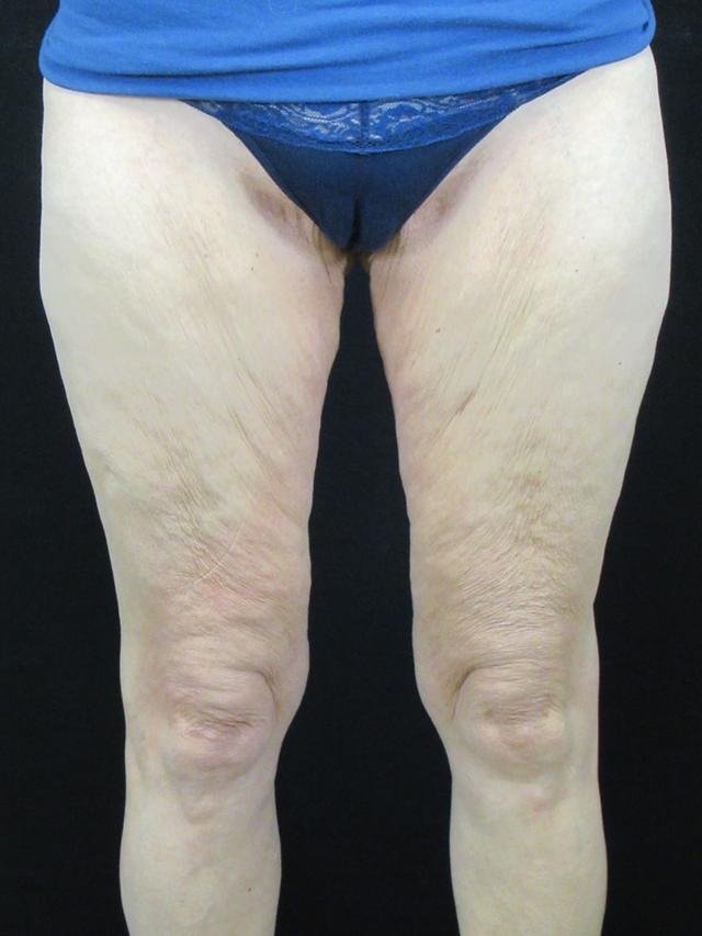 CoolSculpting before at Reynolds Plastic Surgery in Las Vegas, NV