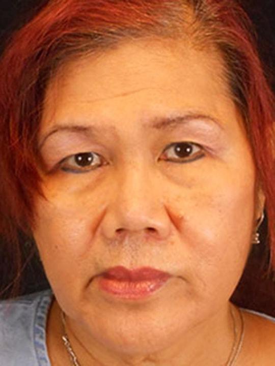 Reynolds Plastic Surgery rhinoplasty after — Las Vegas, NV