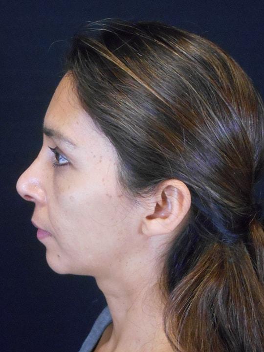 Reynolds Plastic Surgery rhinoplasty after — Las Vegas, NV