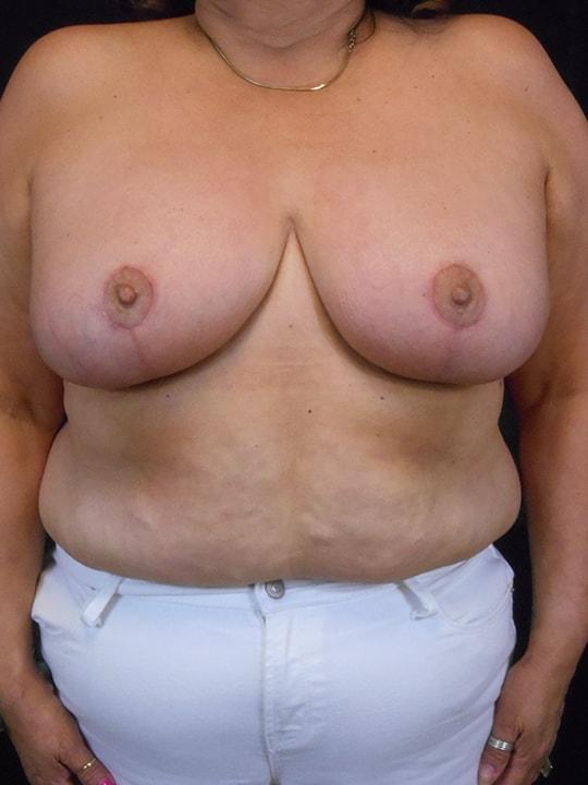Breast Reduction after at Reynolds Plastic Surgery in Las Vegas, NV