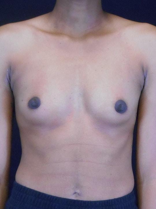 Fat Transfer Breast Augmentation before at Reynolds Plastic Surgery in Las Vegas, NV