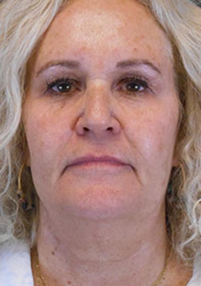 Facelift before at Reynolds Plastic Surgery in Las Vegas, NV