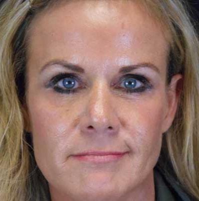 Reynolds Plastic Surgery rhinoplasty after — Las Vegas, NV