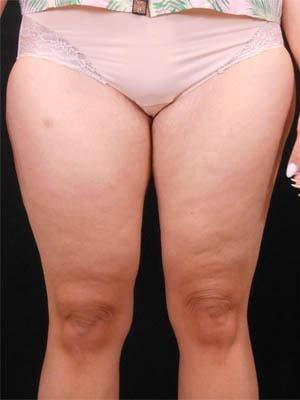 CoolSculpting before at Reynolds Plastic Surgery in Las Vegas, NV