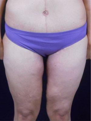 CoolSculpting after at Reynolds Plastic Surgery in Las Vegas, NV