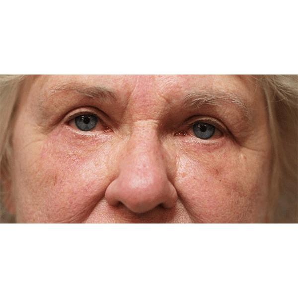 Fante Eye & Face Centre eyelid lift after — Denver, CO