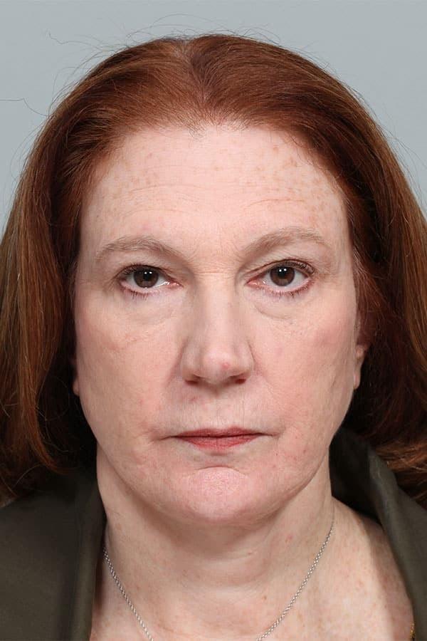 Neck Lift after at Fante Eye & Face Centre in Denver, CO