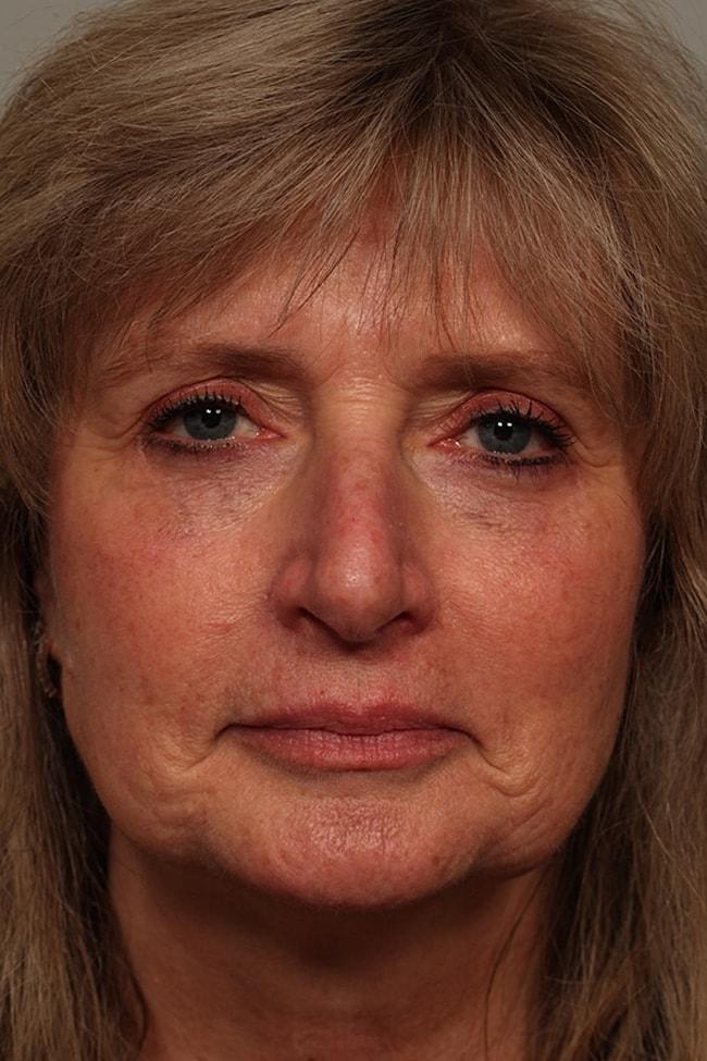 Fante Eye & Face Centre fat transfer after — Denver, CO