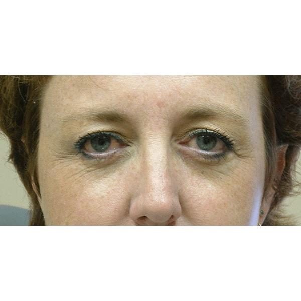 Brow Lift before at Fante Eye & Face Centre in Denver, CO