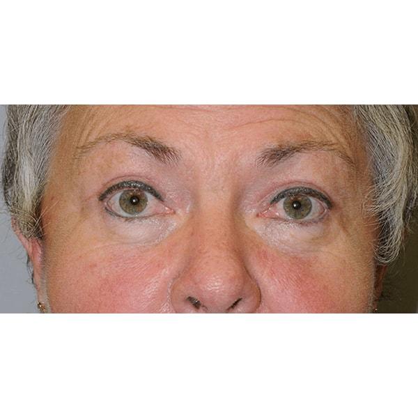 Fante Eye & Face Centre eyelid lift after — Denver, CO