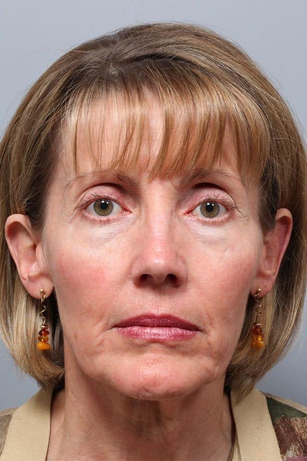Neck Lift before at Fante Eye & Face Centre in Denver, CO
