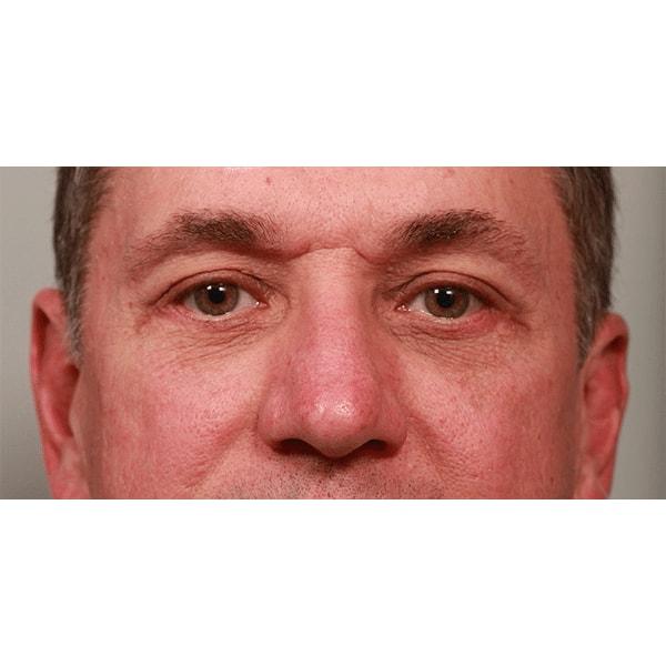Fante Eye & Face Centre eyelid lift after — Denver, CO