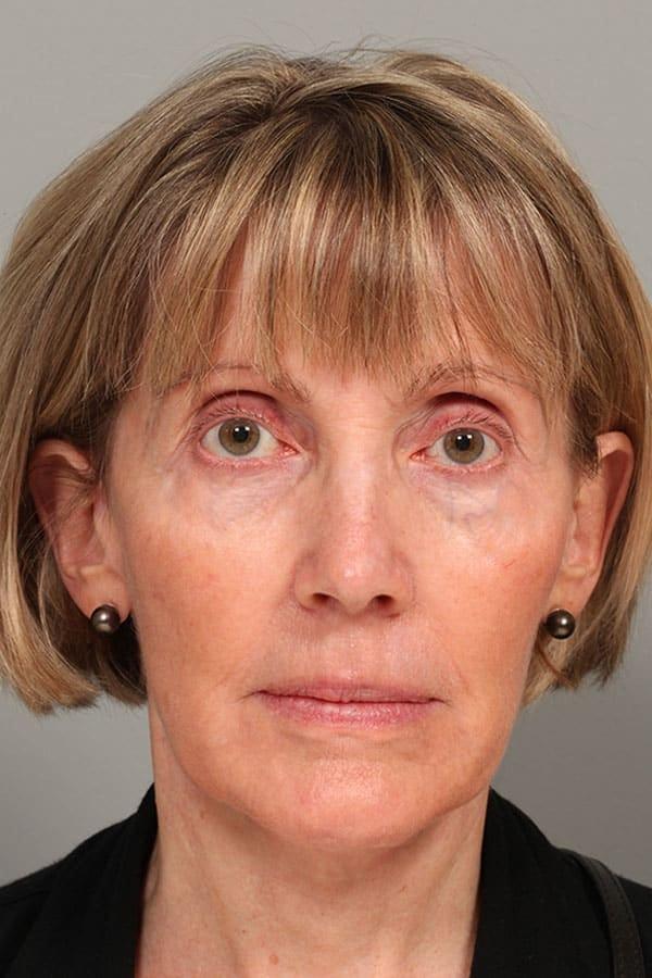 Neck Lift after at Fante Eye & Face Centre in Denver, CO