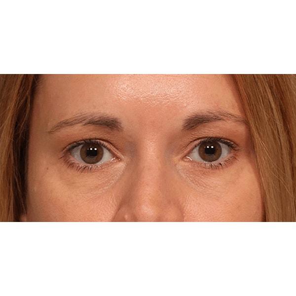 Brow Lift after at Fante Eye & Face Centre in Denver, CO