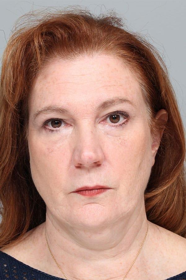 Neck Lift before at Fante Eye & Face Centre in Denver, CO
