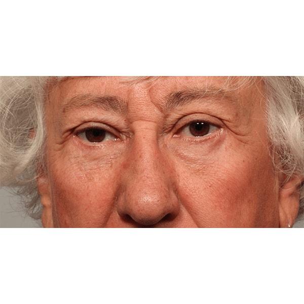 Fante Eye & Face Centre eyelid lift after — Denver, CO