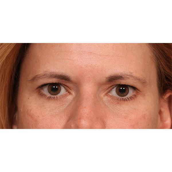 Brow Lift before at Fante Eye & Face Centre in Denver, CO
