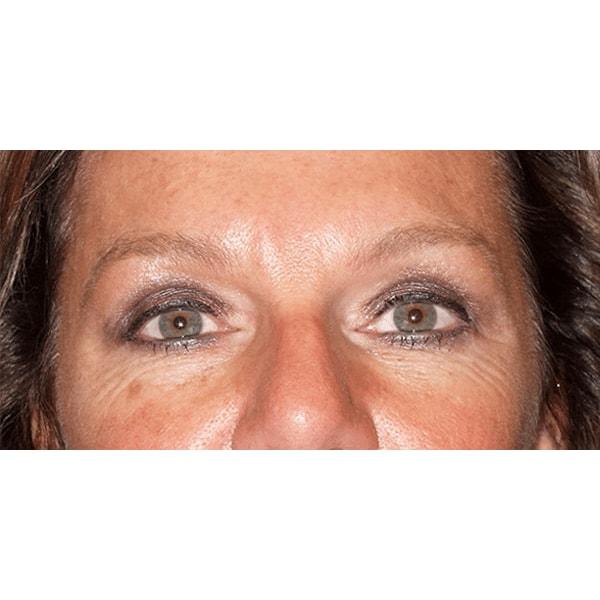 Fante Eye & Face Centre eyelid lift after — Denver, CO