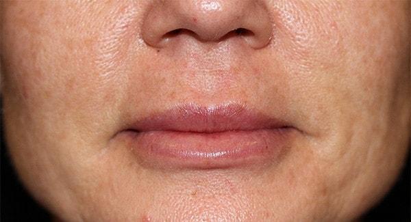 Fante Eye & Face Centre lip filler after — Denver, CO