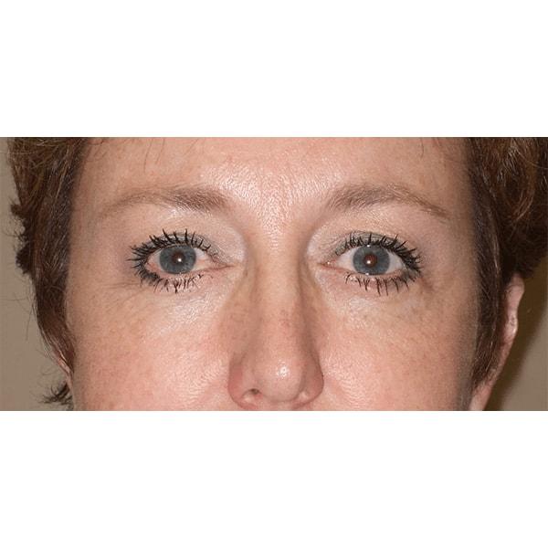 Brow Lift after at Fante Eye & Face Centre in Denver, CO
