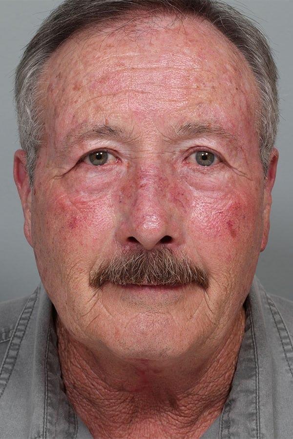Neck Lift after at Fante Eye & Face Centre in Denver, CO