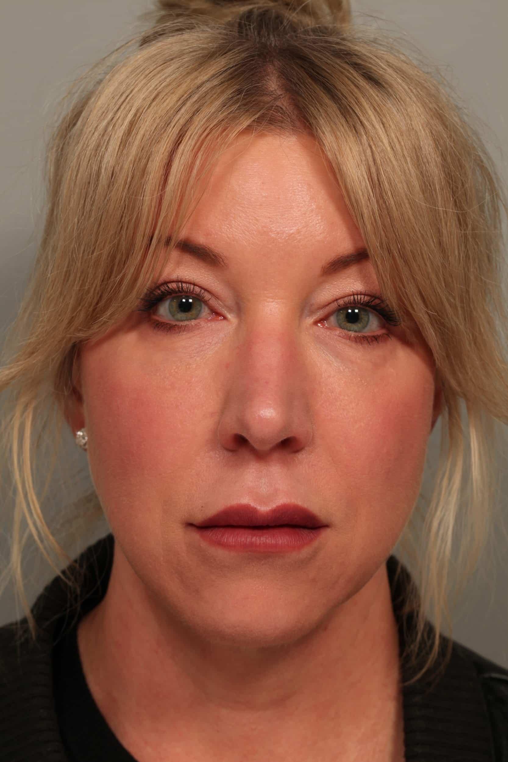 Fante Eye & Face Centre neck liposuction after — Denver, CO