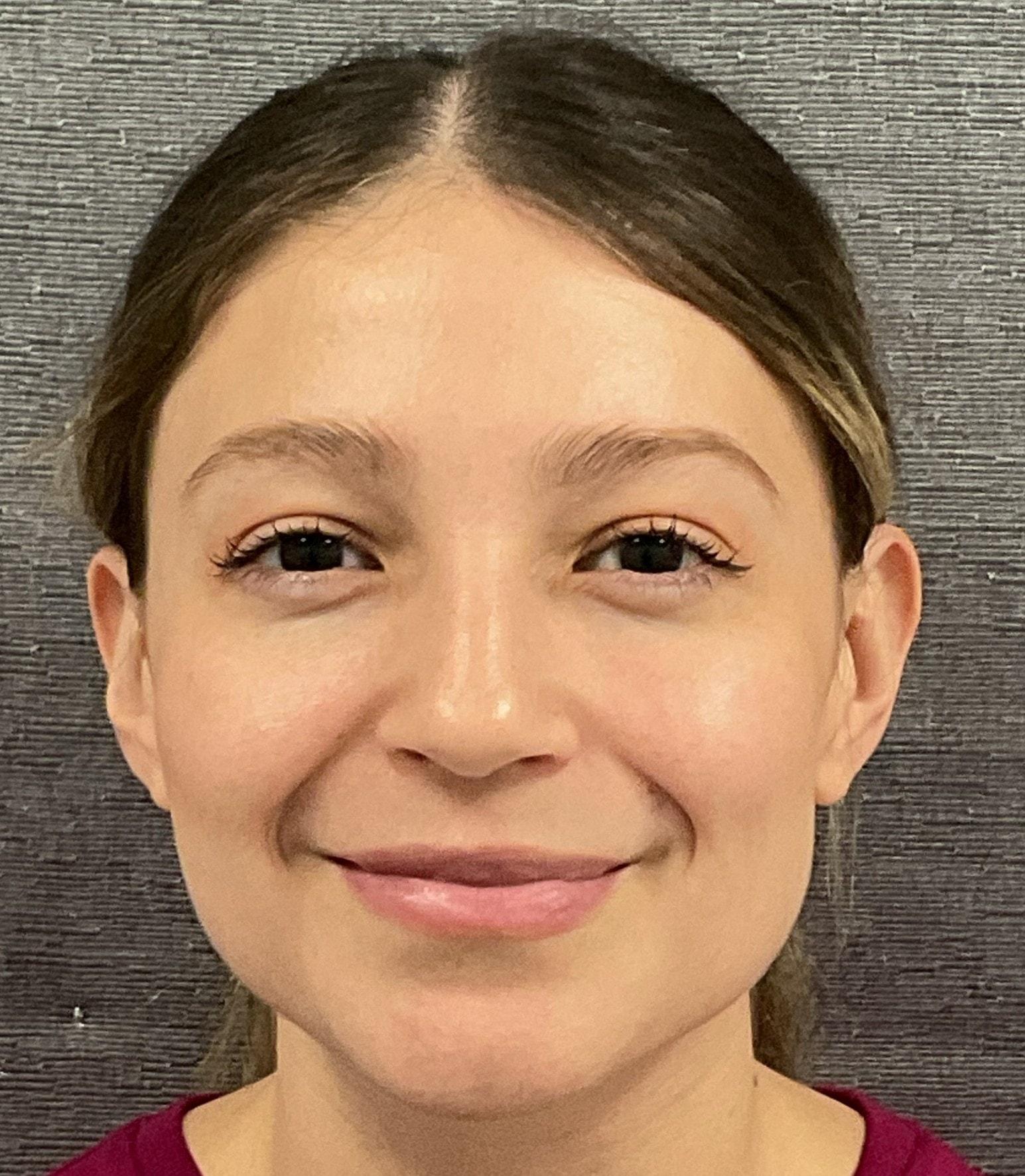 Plastic Surgery Center lip filler after — Wichita, KS