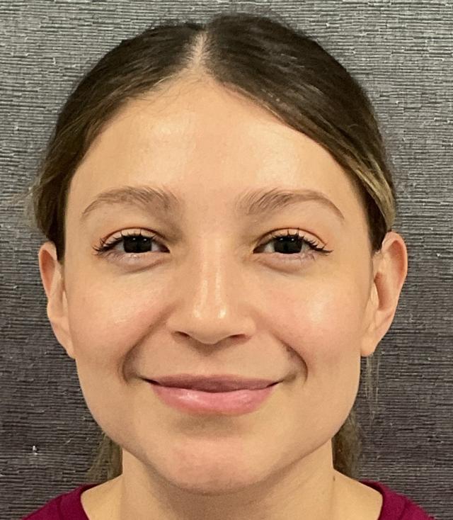 Juvederm after at Plastic Surgery Center in Wichita, KS