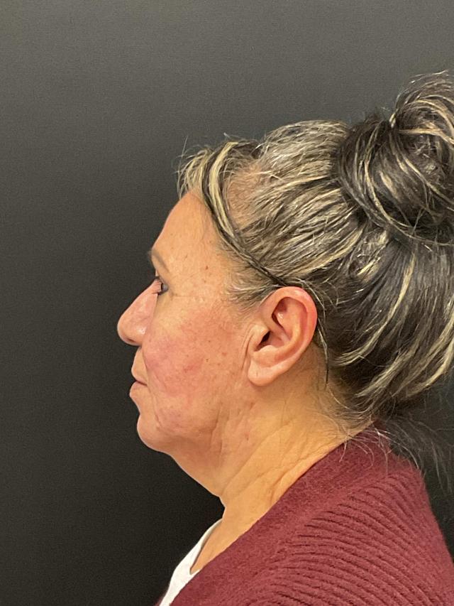 Facelift before at Plastic Surgery Center in Wichita, KS