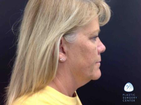 Chemical Peel before at Plastic Surgery Center in Wichita, KS
