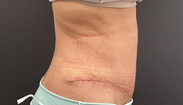 Mini Tummy Tuck after at Plastic Surgery Center in Wichita, KS