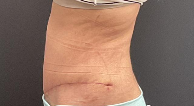 Mini Tummy Tuck after at Plastic Surgery Center in Wichita, KS