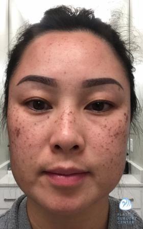 Chemical Peel before at Plastic Surgery Center in Wichita, KS