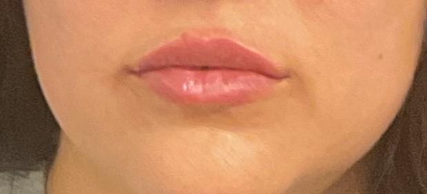 Lip Filler after at Plastic Surgery Center in Wichita, KS