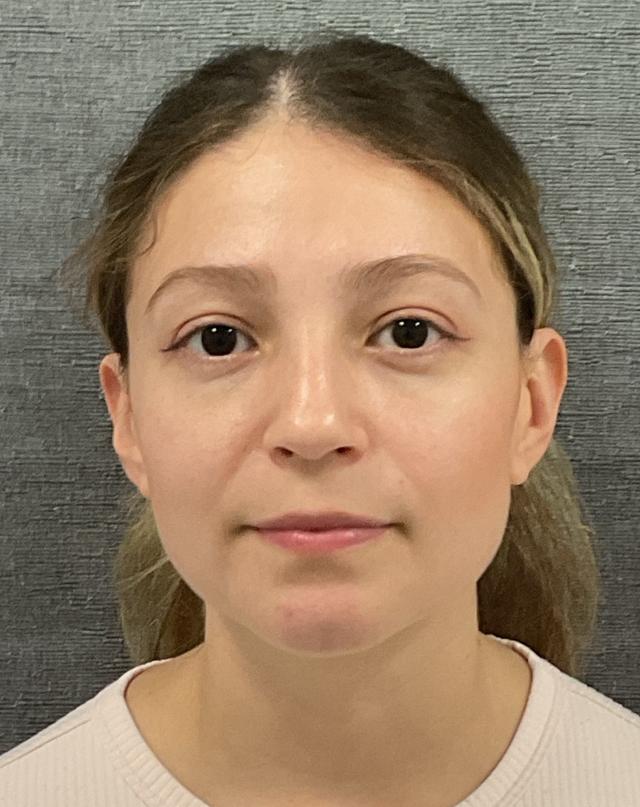 Juvederm before at Plastic Surgery Center in Wichita, KS