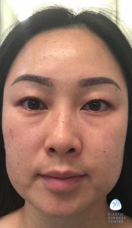 Chemical Peel after at Plastic Surgery Center in Wichita, KS