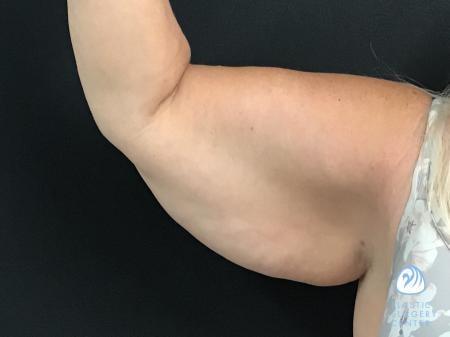 Arm Lift before at Plastic Surgery Center in Wichita, KS