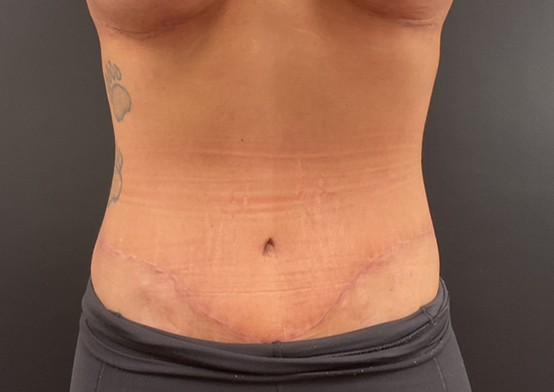 Plastic Surgery Center after — Wichita, KS