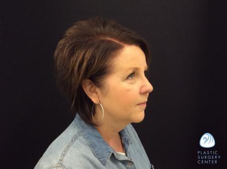 Chemical Peel after at Plastic Surgery Center in Wichita, KS