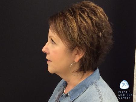 Chemical Peel after at Plastic Surgery Center in Wichita, KS